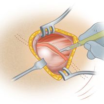 posterior decompression