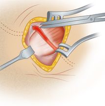 anterior decompression